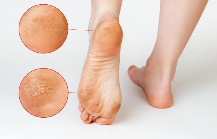 Foot Skin Concerns