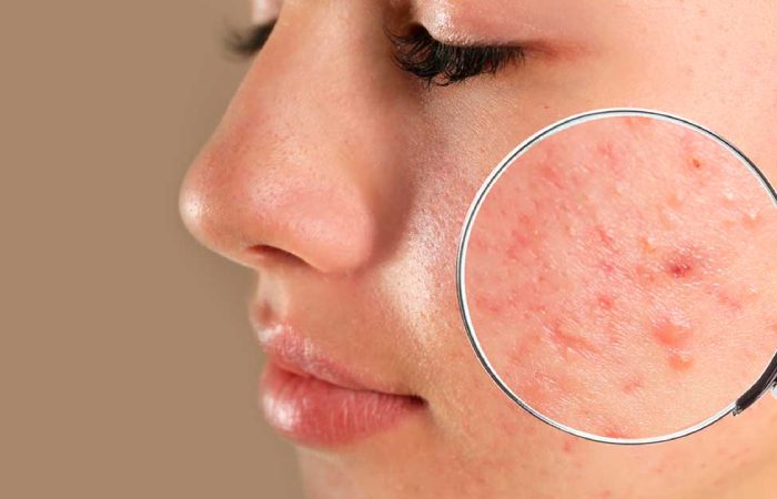 What Causes Acne